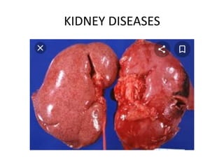 KIDNEY DISEASES
 