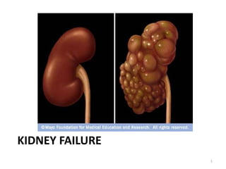 Kidney Failure 1 