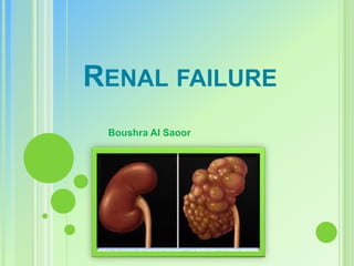 RENAL FAILURE
 Boushra Al Saoor
 