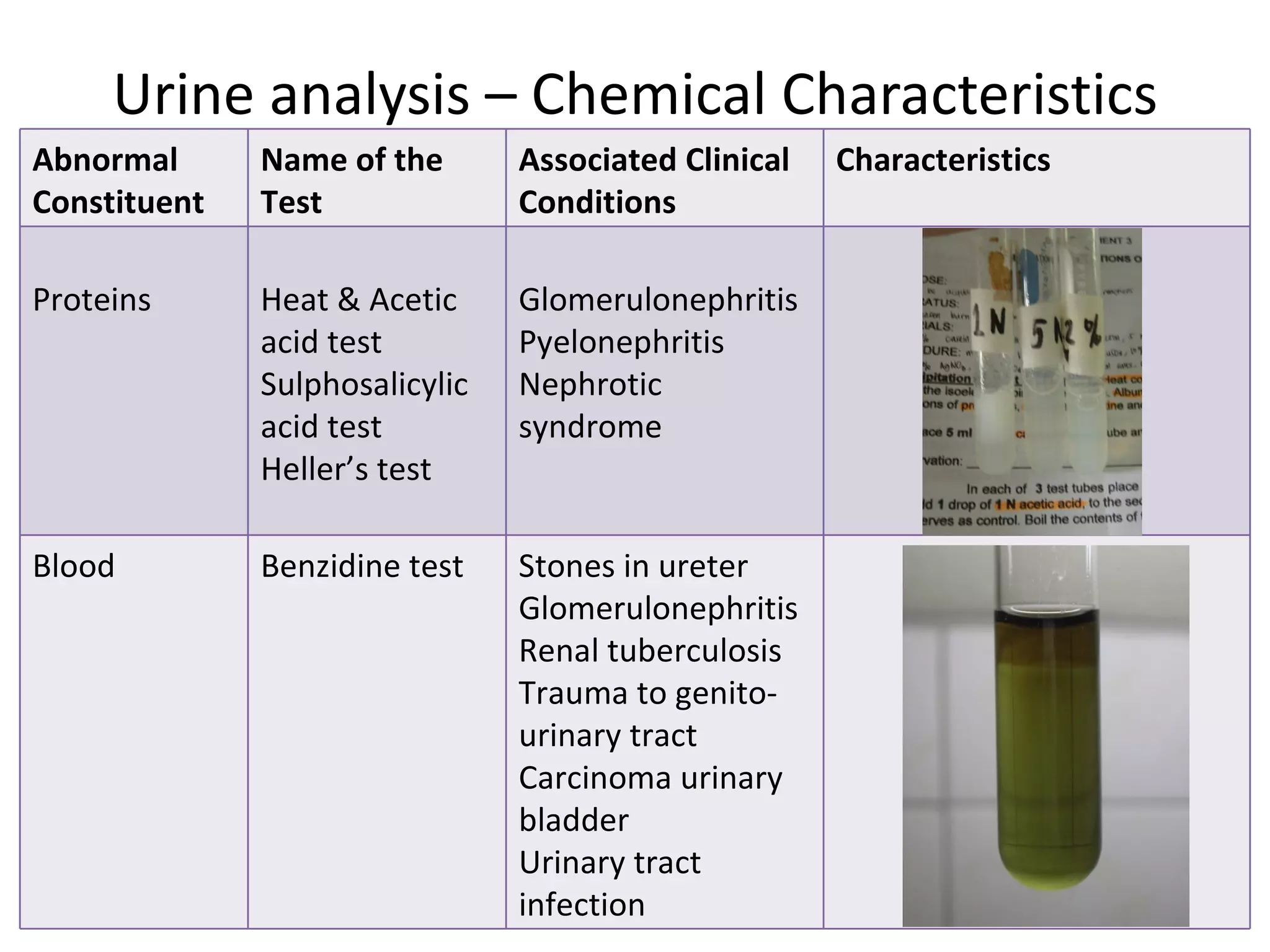 Urine analysis – Chemical Characteristics
Abnormal      Name of the       Associated Clinical   Characteristics
Constituent   Test              Conditions

Proteins      Heat & Acetic     Glomerulonephritis
              acid test         Pyelonephritis
              Sulphosalicylic   Nephrotic
              acid test         syndrome
              Heller’s test

Blood         Benzidine test    Stones in ureter
                                Glomerulonephritis
                                Renal tuberculosis
                                Trauma to genito-
                                urinary tract
                                Carcinoma urinary
                                bladder
                                Urinary tract
                                infection                               12
 