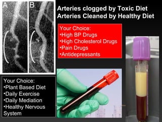 Arteries clogged by Toxic Diet
Arteries Cleaned by Healthy Diet
Your Choice:
•High BP Drugs
•High Cholesterol Drugs
•Pain Drugs
•Antidepressants
Your Choice:
•Plant Based Diet
•Daily Exercise
•Daily Mediation
•Healthy Nervous
System
 