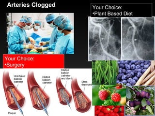 Your Choice:
•Surgery
Arteries Clogged Your Choice:
•Plant Based Diet
 