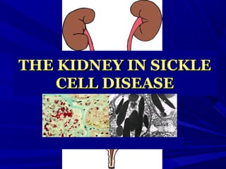 THE KIDNEY IN SICKLETHE KIDNEY IN SICKLE
CELL DISEASECELL DISEASE
 