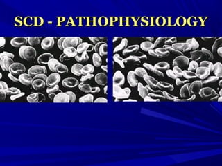 SCD - PATHOPHYSIOLOGYSCD - PATHOPHYSIOLOGY
 