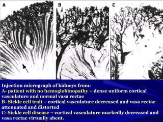 Injection micrograph of kidneys from:Injection micrograph of kidneys from:
A- patient with no hemoglobinopathyA- patient with no hemoglobinopathy – dense uniform cortical– dense uniform cortical
vasculature and normal vasa rectaevasculature and normal vasa rectae
B- Sickle cell traitB- Sickle cell trait – cortical vasculature decreased and vasa rectae– cortical vasculature decreased and vasa rectae
attenuated and distortedattenuated and distorted
C- Sickle cell diseaseC- Sickle cell disease – cortical vasculature markedly decreased and– cortical vasculature markedly decreased and
vasa rectae virtually abent.vasa rectae virtually abent.
 
