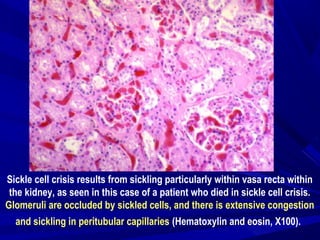 Sickle cell crisis results from sickling particularly within vasa recta within
the kidney, as seen in this case of a patient who died in sickle cell crisis.
Glomeruli are occluded by sickled cells, and there is extensive congestion
and sickling in peritubular capillaries (Hematoxylin and eosin, X100).
 