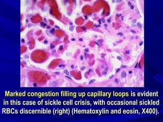 Marked congestion filling up capillary loopsMarked congestion filling up capillary loops is evidentis evident
in this case of sickle cell crisis, with occasional sickledin this case of sickle cell crisis, with occasional sickled
RBCs discernible (right) (Hematoxylin and eosin, X400).RBCs discernible (right) (Hematoxylin and eosin, X400).
 