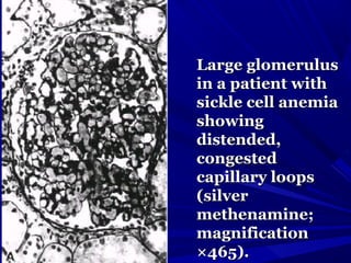 Large glomerulusLarge glomerulus
in a patient within a patient with
sickle cell anemiasickle cell anemia
showingshowing
distended,distended,
congestedcongested
capillary loopscapillary loops
(silver(silver
methenamine;methenamine;
magnificationmagnification
×465).×465).
 