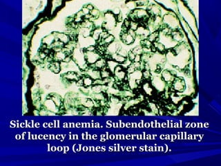 Sickle cell anemia. Subendothelial zoneSickle cell anemia. Subendothelial zone
of lucency in the glomerular capillaryof lucency in the glomerular capillary
loop (Jones silver stain).loop (Jones silver stain).
 