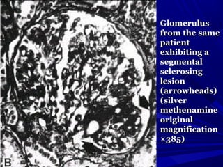 GlomerulusGlomerulus
from the samefrom the same
patientpatient
exhibiting aexhibiting a
segmentalsegmental
sclerosingsclerosing
lesionlesion
(arrowheads)(arrowheads)
(silver(silver
methenaminemethenamine
originaloriginal
magnificationmagnification
×385)×385)
 