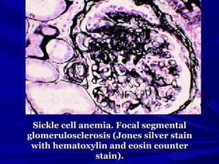 Sickle cell anemia. Focal segmentalSickle cell anemia. Focal segmental
glomerulosclerosis (Jones silver stainglomerulosclerosis (Jones silver stain
with hematoxylin and eosin counterwith hematoxylin and eosin counter
stain).stain).
 