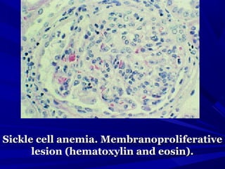 Sickle cell anemia. MembranoproliferativeSickle cell anemia. Membranoproliferative
lesion (hematoxylin and eosin).lesion (hematoxylin and eosin).
 