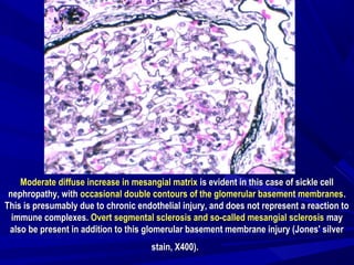 Moderate diffuse increase in mesangial matrixModerate diffuse increase in mesangial matrix is evident in this case of sickle cellis evident in this case of sickle cell
nephropathy, withnephropathy, with occasional double contours of the glomerular basement membranesoccasional double contours of the glomerular basement membranes..
This is presumably due to chronic endothelial injury, and does not represent a reaction toThis is presumably due to chronic endothelial injury, and does not represent a reaction to
immune complexes.immune complexes. Overt segmental sclerosis and so-called mesangial sclerosisOvert segmental sclerosis and so-called mesangial sclerosis maymay
also be present in addition to this glomerular basement membrane injury (Jones' silveralso be present in addition to this glomerular basement membrane injury (Jones' silver
stain, X400).stain, X400).
 