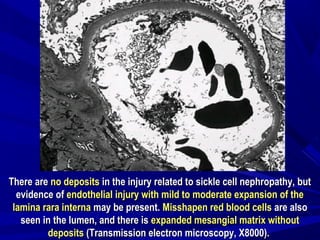 There areThere are no depositsno deposits in the injury related to sickle cell nephropathy, butin the injury related to sickle cell nephropathy, but
evidence ofevidence of endothelial injury with mild to moderate expansion of theendothelial injury with mild to moderate expansion of the
lamina rara internalamina rara interna may be present.may be present. Misshapen red blood cellsMisshapen red blood cells are alsoare also
seen in the lumen, and there isseen in the lumen, and there is expanded mesangial matrix withoutexpanded mesangial matrix without
depositsdeposits (Transmission electron microscopy, X8000).(Transmission electron microscopy, X8000).
 