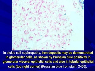 In sickle cell nephropathy,In sickle cell nephropathy, iron deposits may be demonstratediron deposits may be demonstrated
in glomerular cells, as shown by Prussian blue positivity inin glomerular cells, as shown by Prussian blue positivity in
glomerular visceral epithelial cells and also in tubular epithelialglomerular visceral epithelial cells and also in tubular epithelial
cells (top right corner)cells (top right corner) (Prussian blue iron stain, X400).(Prussian blue iron stain, X400).
 