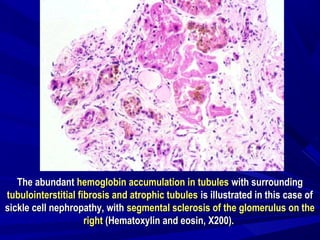 The abundantThe abundant hemoglobin accumulation in tubuleshemoglobin accumulation in tubules with surroundingwith surrounding
tubulointerstitial fibrosis and atrophic tubulestubulointerstitial fibrosis and atrophic tubules is illustrated in this case ofis illustrated in this case of
sickle cell nephropathy, withsickle cell nephropathy, with segmental sclerosis of the glomerulus on thesegmental sclerosis of the glomerulus on the
rightright (Hematoxylin and eosin, X200).(Hematoxylin and eosin, X200).
 