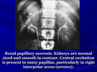 Renal papillary necrosis. Kidneys are normalRenal papillary necrosis. Kidneys are normal
sized and smooth in contour. Central cavitationsized and smooth in contour. Central cavitation
is present in many papillae, particularly in rightis present in many papillae, particularly in right
interpolar areas (arrows).interpolar areas (arrows).
 