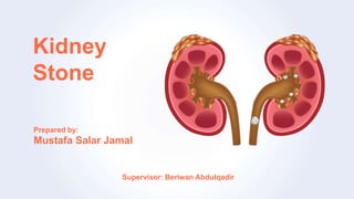 Kidney
Stone
Prepared by:
Mustafa Salar Jamal
Supervisor: Beriwan Abdulqadir
 