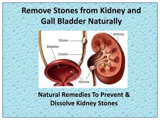 Remove Stones from Kidney and
Gall Bladder Naturally
Natural Remedies To Prevent &
Dissolve Kidney Stones
 