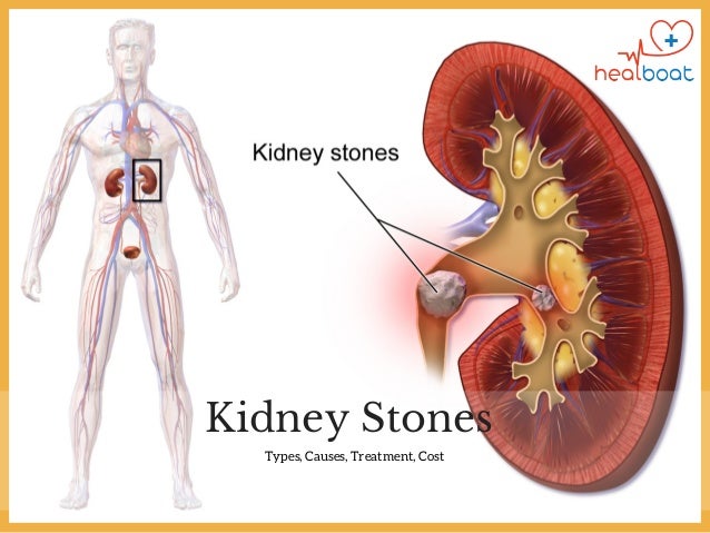 Best Diet to Prevent Kidney Stones 
