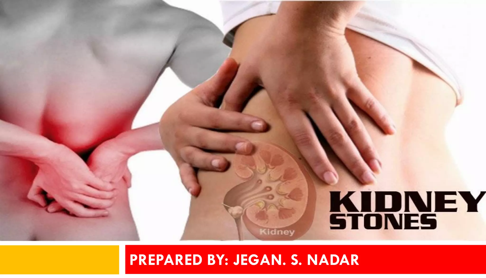 Pathophysiology of Kidney stones