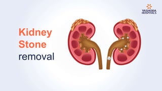 Kidney
Stone
removal
 