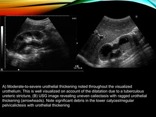 Caliectasis Radiopaedia IMAGING FEATURES IN RENAL TUBERCULOSIS | PPTX