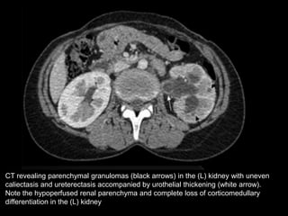 Caliectasis Radiopaedia IMAGING FEATURES IN RENAL TUBERCULOSIS | PPTX
