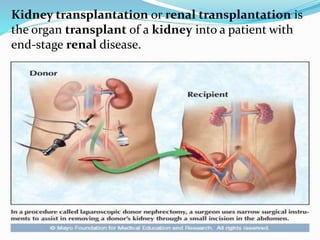 Kidney transplantation | PPTX