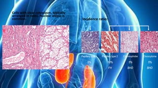 Cells with clear cytoplasm, typically
arranged in nests. Nuclear atypia is
common. Incidence ratio:
 