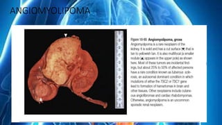 ANGIOMYOLIPOMA
 