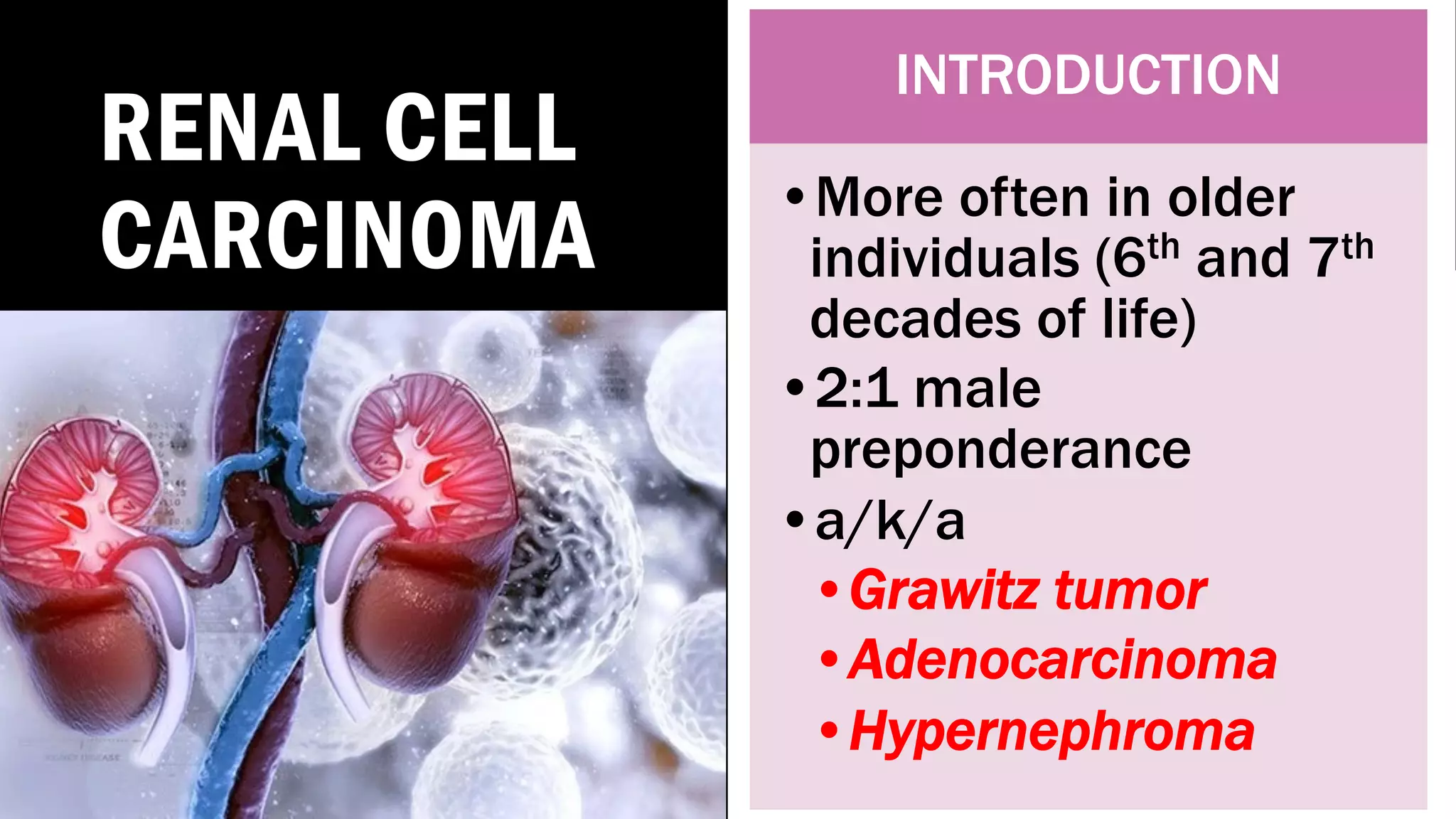 RENAL CELL
CARCINOMA
INTRODUCTION
•More often in older
individuals (6th and 7th
decades of life)
•2:1 male
preponderance
•a/k/a
•Grawitz tumor
•Adenocarcinoma
•Hypernephroma
 