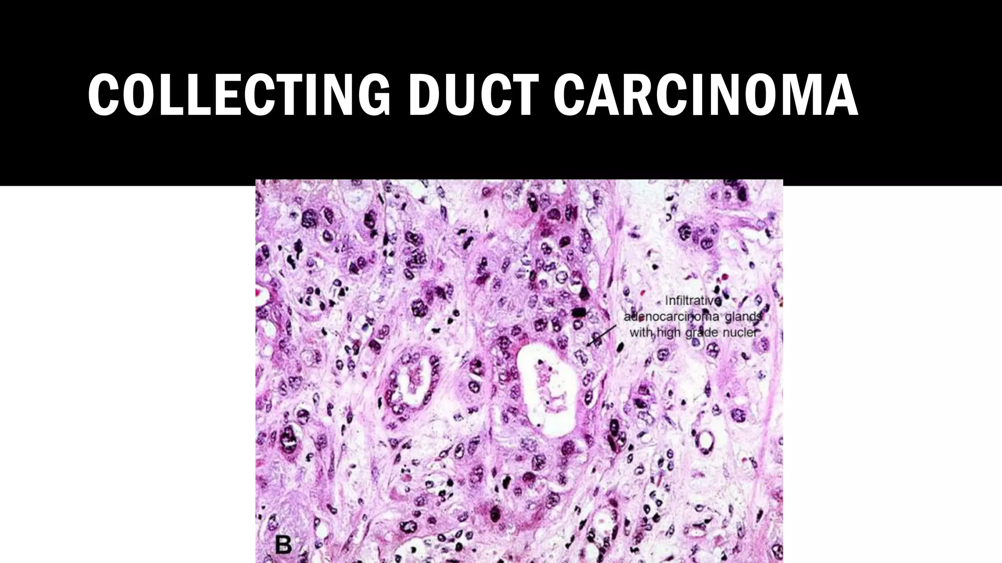COLLECTING DUCT CARCINOMA
 