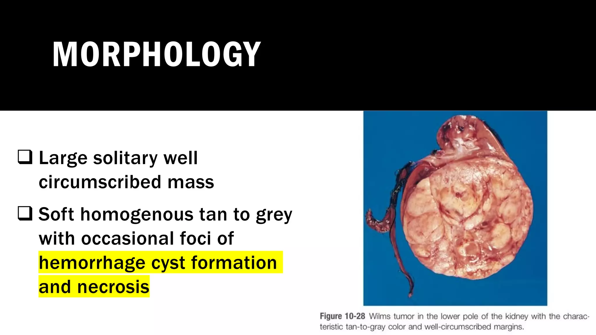 MORPHOLOGY
q Large solitary well
circumscribed mass
q Soft homogenous tan to grey
with occasional foci of
hemorrhage cyst formation
and necrosis
 