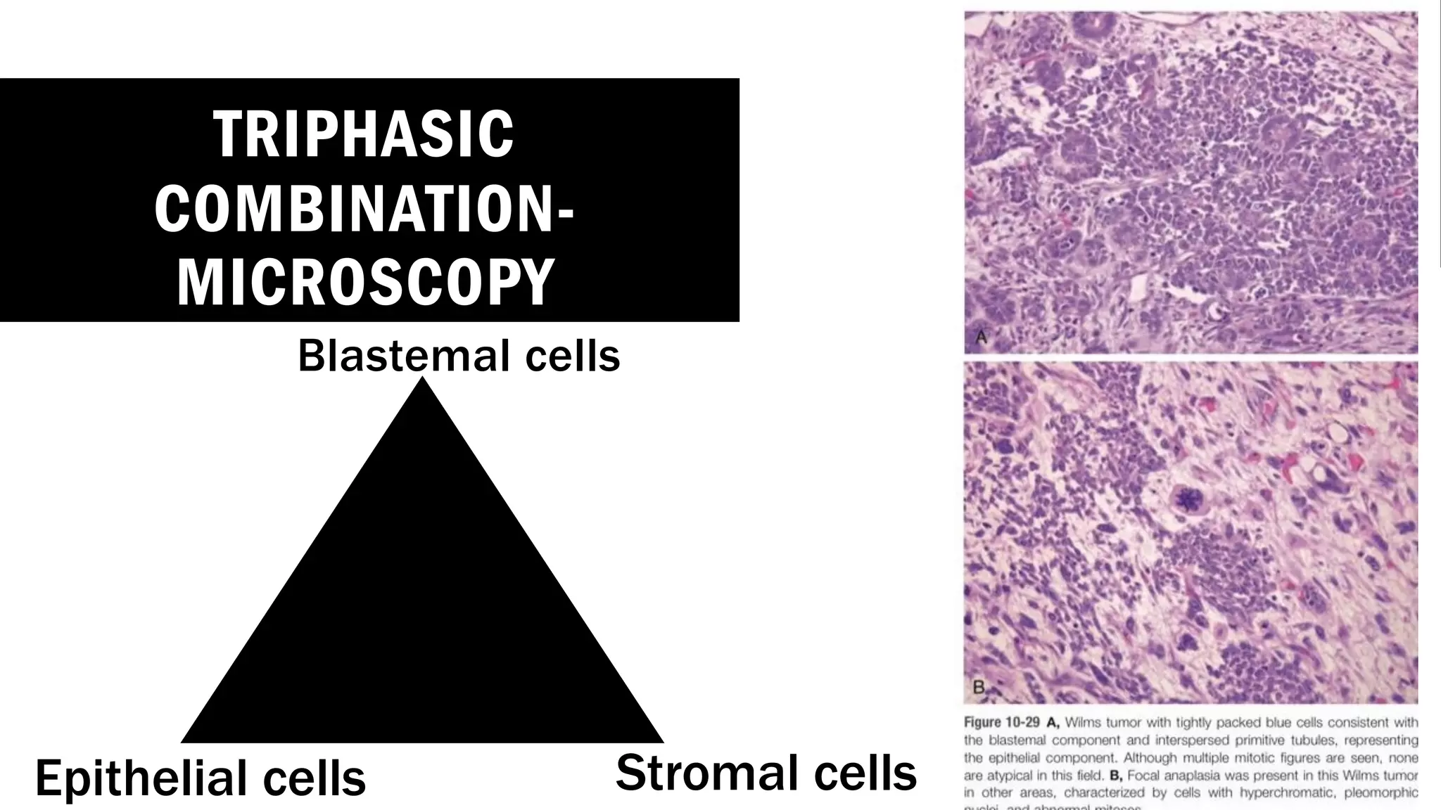 TRIPHASIC
COMBINATION-
MICROSCOPY
Blastemal cells
Stromal cells
Epithelial cells
 