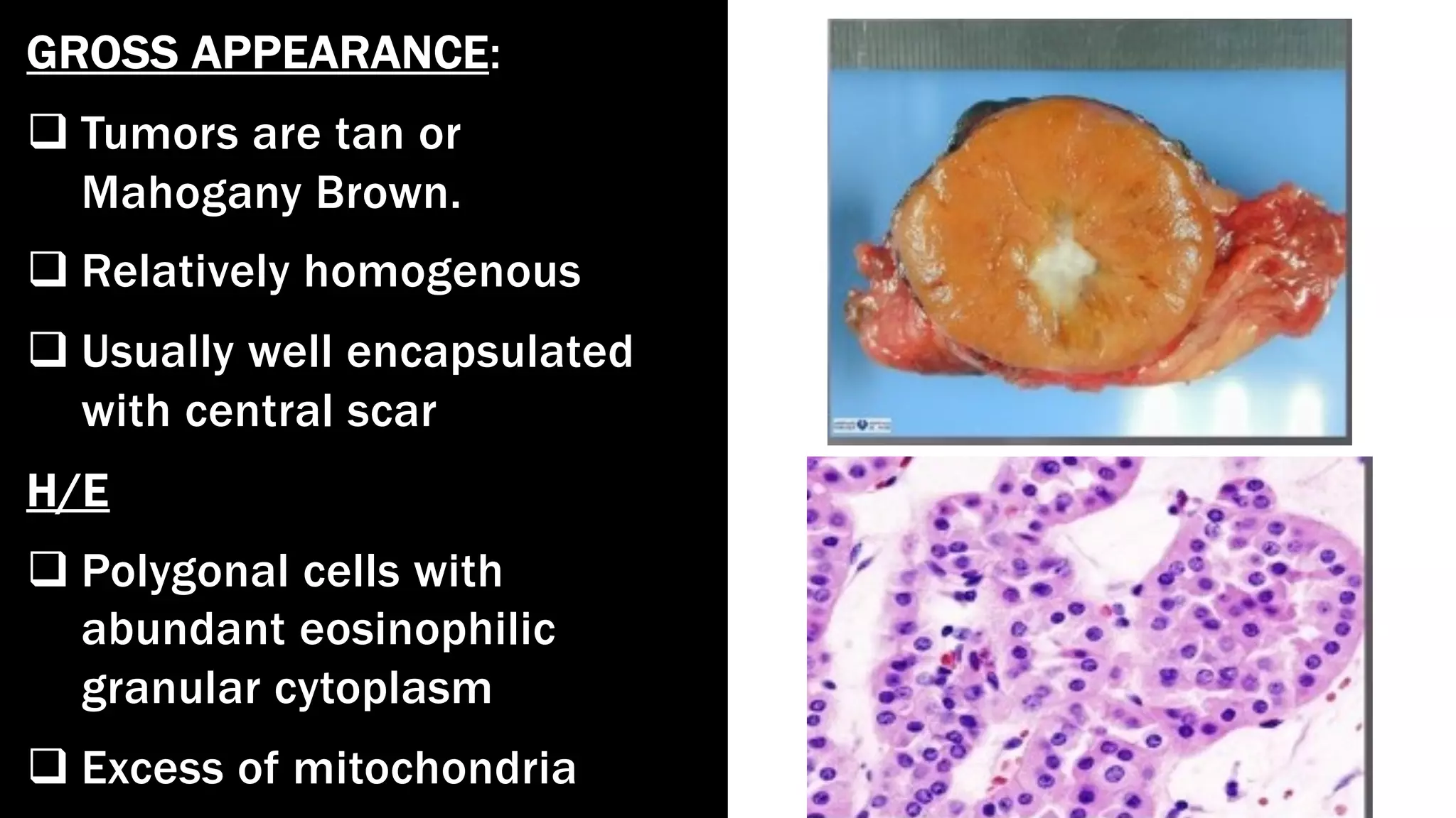 GROSS APPEARANCE:
q Tumors are tan or
Mahogany Brown.
q Relatively homogenous
q Usually well encapsulated
with central scar
H/E
q Polygonal cells with
abundant eosinophilic
granular cytoplasm
q Excess of mitochondria
 