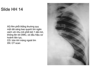 Slide HH 14
XQ film phổi thẳng thường quy
một dải sáng bao quanh tim ngăn
cách với nhu mô phổi bởi 1 dải mờ,
không lên tới DMC, có dấu hiệu cơ
hoành liên tục,
CD: tràn khí màng ngoài tim
XN: CT scan
 