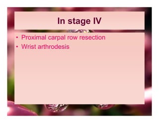 In stage IV
• Proximal carpal row resection
• Wrist arthrodesis
 