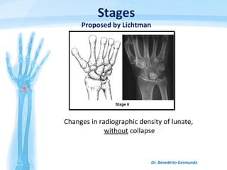 Dr. Benedetto Gesmundo
Changes in radiographic density of lunate,
without collapse
Stages
Proposed by Lichtman
 