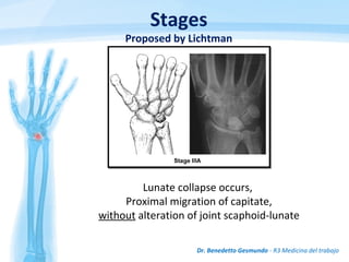 Dr. Benedetto Gesmundo - R3 Medicina del trabajo
Lunate collapse occurs,
Proximal migration of capitate,
without alteration of joint scaphoid-lunate
Stages
Proposed by Lichtman
 