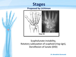 Dr. Benedetto Gesmundo
Scapholunate instability,
Rotatory subluxation of scaphoid (ring sign),
Dorsiflexion of lunate (DISI)
Stages
Proposed by Lichtman
 