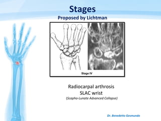 Dr. Benedetto Gesmundo
Radiocarpal arthrosis
SLAC wrist
(Scapho-Lunate Advanced Collapse)
Stages
Proposed by Lichtman
 