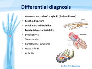 Differential diagnosis
• Avascular necrosis of scaphoid (Preiser disease)
• Scaphoid fracture
• Scapholunate instability
• Lunate-triquetral instability
• Synovial cysts
• Tenosynovitis
• Carpal tunnel syndrome
• Osteoarthritis
• Arthritis
Dr. Benedetto Gesmundo
 