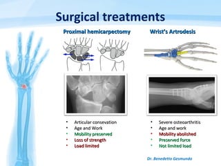Surgical treatments
Dr. Benedetto Gesmundo
Proximal hemicarpectomyProximal hemicarpectomy
• Articular consevationArticular consevation
• Age and WorkAge and Work
• Mobility preservedMobility preserved
• Loss of strengthLoss of strength
• Load limitedLoad limited
• Severe osteoarthritisSevere osteoarthritis
• Age and workAge and work
• Mobility abolishedMobility abolished
• Preserved forcePreserved force
• Not limited loadNot limited load
Wrist’s ArtrodesisWrist’s Artrodesis
 