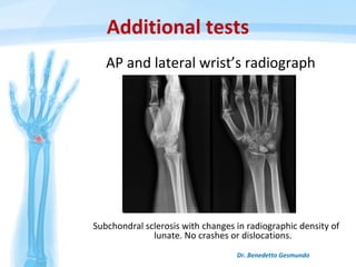 Additional tests
AP and lateral wrist’s radiograph
Dr. Benedetto Gesmundo
Subchondral sclerosis with changes in radiographic density of
lunate. No crashes or dislocations.
 