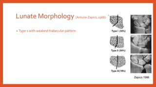 Lunate Morphology (Antuna-Zapico, 1966)
• Type 1 with weakest trabecular pattern
 