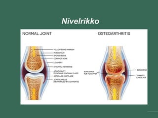 Nivelrikko
 
