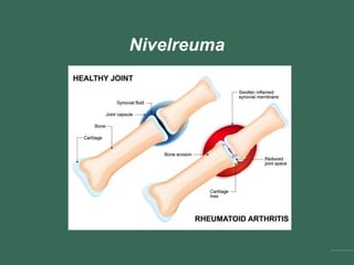 Nivelreuma
 