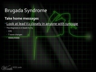 Take home messages
•Look at leadV2 closely in anyone with syncope
• The diagnosis is in leadsV1-V3
• STE
• T wave changes
• RBBB/IRBBB
Brugada Syndrome
 
