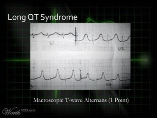 Long QT Syndrome
Macroscopic T-wave Alternans (1 Point)
 